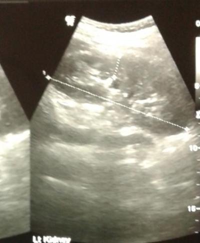 Figure 1: USG revealed a dilated proximal CBD and right intra-hepatic ducts with tubular hyper-echoic structure and mild splenomegaly.